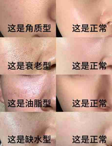 毛孔粗大日常收缩护理妙招/毛孔粗大 收缩毛孔用什么护肤品好